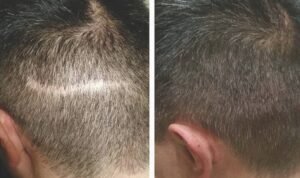 Scalp Micropigmentation (SMP)